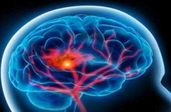 Intracranial Hemorrhages