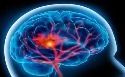 Intracranial Hemorrhages