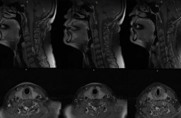 Prof Dr Yusuf Sukru Caglar - C5-C6 schwannoma surgery